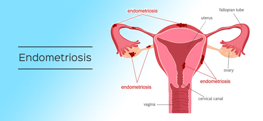 Endometriosis-and-infertility