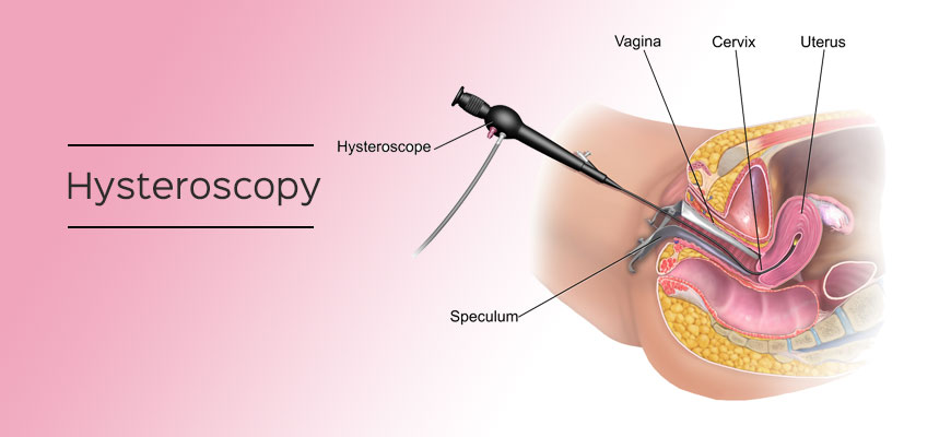 Hysteroscopy-treatment