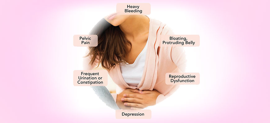 Symptoms-of-Uterine-Fibroids